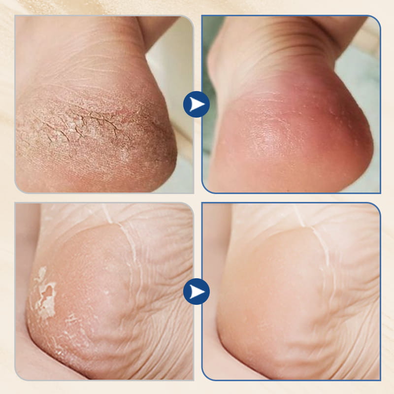 🧴Hydrating and Anti-Cracking Foot Cream